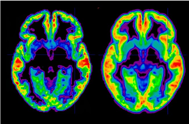 Concussions concussions millcreek