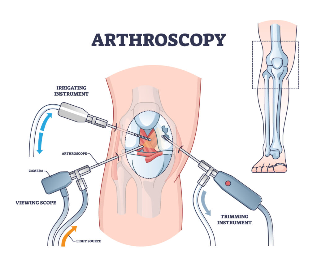 Arthroscopic Knee Surgery