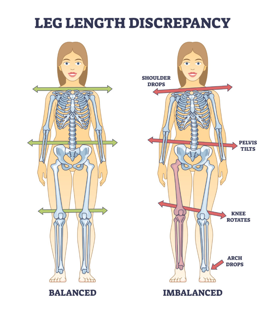 Understanding and Treating Leg Length Discrepancy